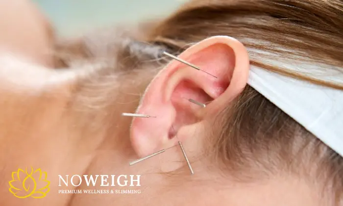 2 Or 3 X Acudetox Acupuncture Sessions 1